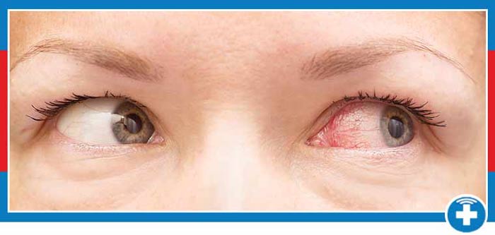 Pink Eye Treatment Near Me in Laredo, TX Pink Eye Treatment Near Me in Laredo, TX