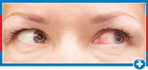 Pink Eye Treatment Near Me in Laredo, TX Pink Eye Treatment Near Me in Laredo, TX
